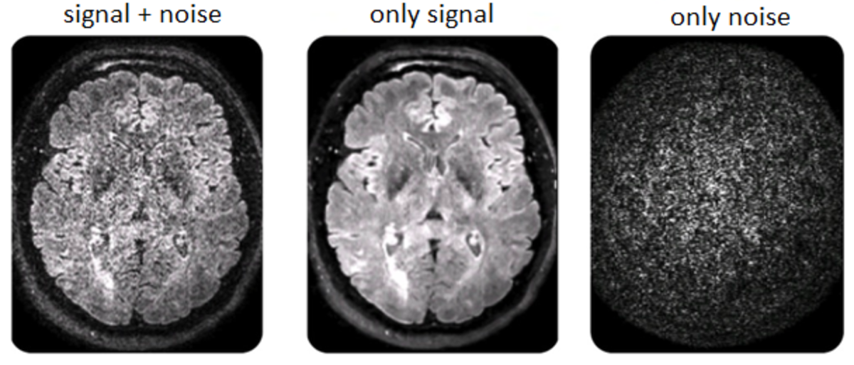 Figure 2. Today's MRI imaging is getting better because of increasingly effective noise filtering techniques. Adapted from Manjon et al. (2010).